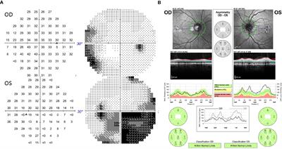 Case Report: Neuromyelitis Optica After Treatment of Uveal Melanoma With Nivolumab and Ipilimumab